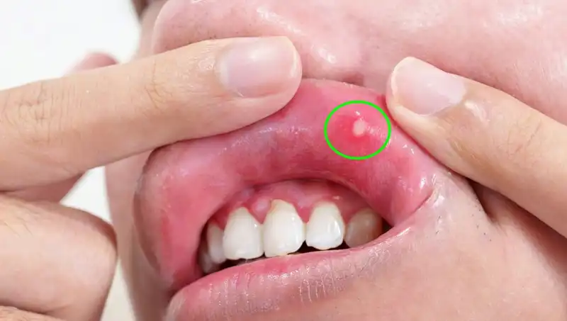 Vücudunuzun İhtiyacı Olan 5 B Vitamini Eksikliği Belirtisi
